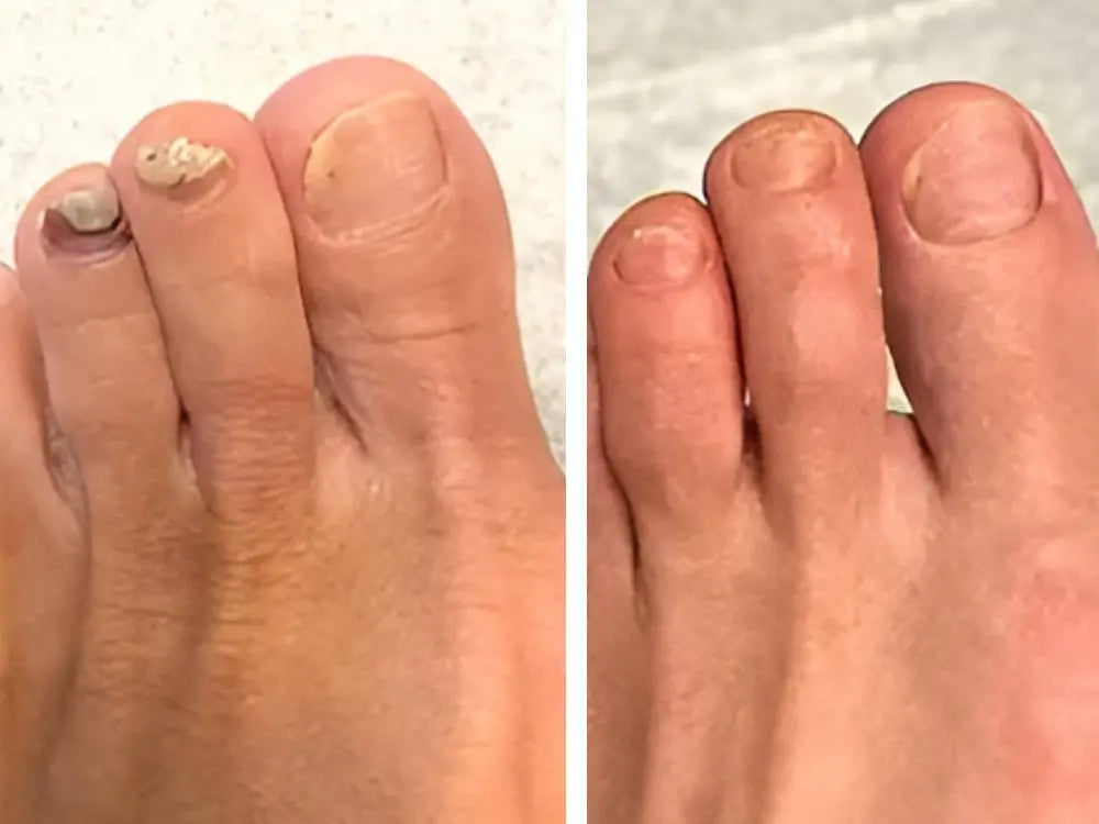 LBMLBM™ Antifungal Pen-UNDECYLENIC ACID25%-Cures Most Athlete's Foot, Jock ltch, andRingworm