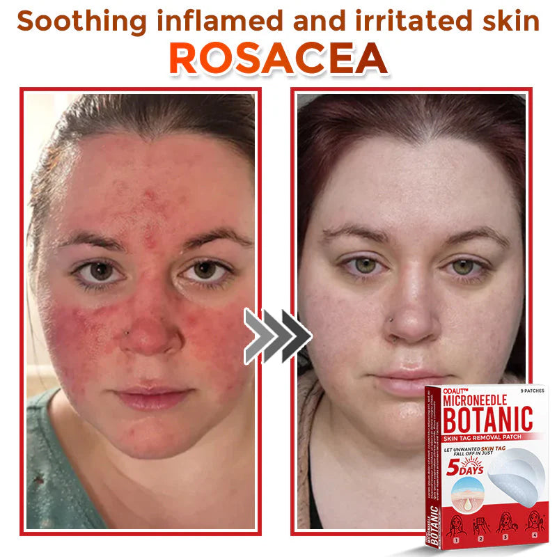 🌈 ODALIT™MicroNeedle Botanic Skin Tag Removal Patch