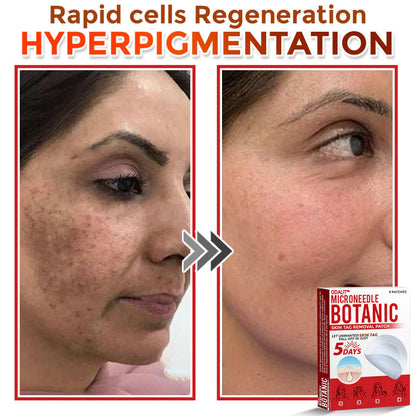 🌈 ODALIT™MicroNeedle Botanic Skin Tag Removal Patch