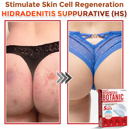 🌈 ODALIT™MicroNeedle Botanic Skin Tag Removal Patch