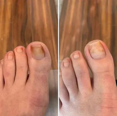 LBMLBM™ Antifungal Pen-UNDECYLENIC ACID25%-Cures Most Athlete's Foot, Jock ltch, andRingworm